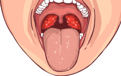 Воспаление горла
